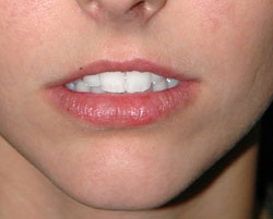 Lip Augmentation - Patient 1 - Before